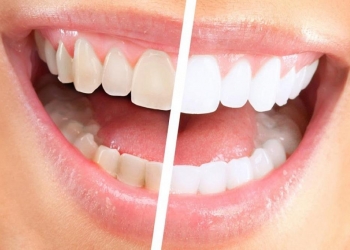 ابتعد عنها فوراً.. 5 عادات شائعة تؤدّي لاصفرار الأسنان