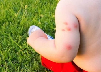 حساسية الحشرات عند الرضع