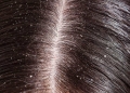 قشرة الشعر