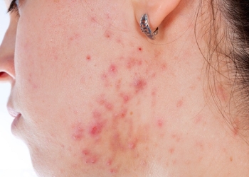 Problems with acnes on the female skin