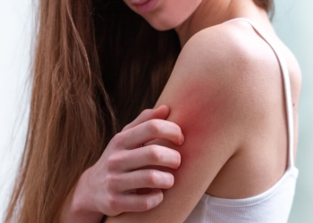 أسباب وطرق علاج الطفح الجلدي الحراري في الشتاء