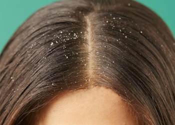 وصفات طبيعية للتخلص من قشرة الشعر.. حافظي عليها
