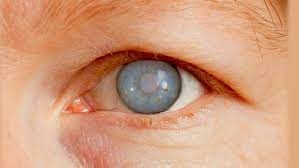 أعراض الجلوكوما قد تقودك إلى العمى