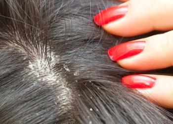 أبرز العلاجات المنزلية لعلاج قشرة الشعر