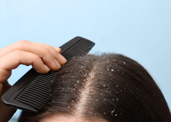 أسباب وأعراض ظهور قشرة الشعر في الشتاء