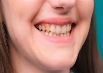 طريقة التخلص من اصفرار الأسنان بمكونات طبيعية